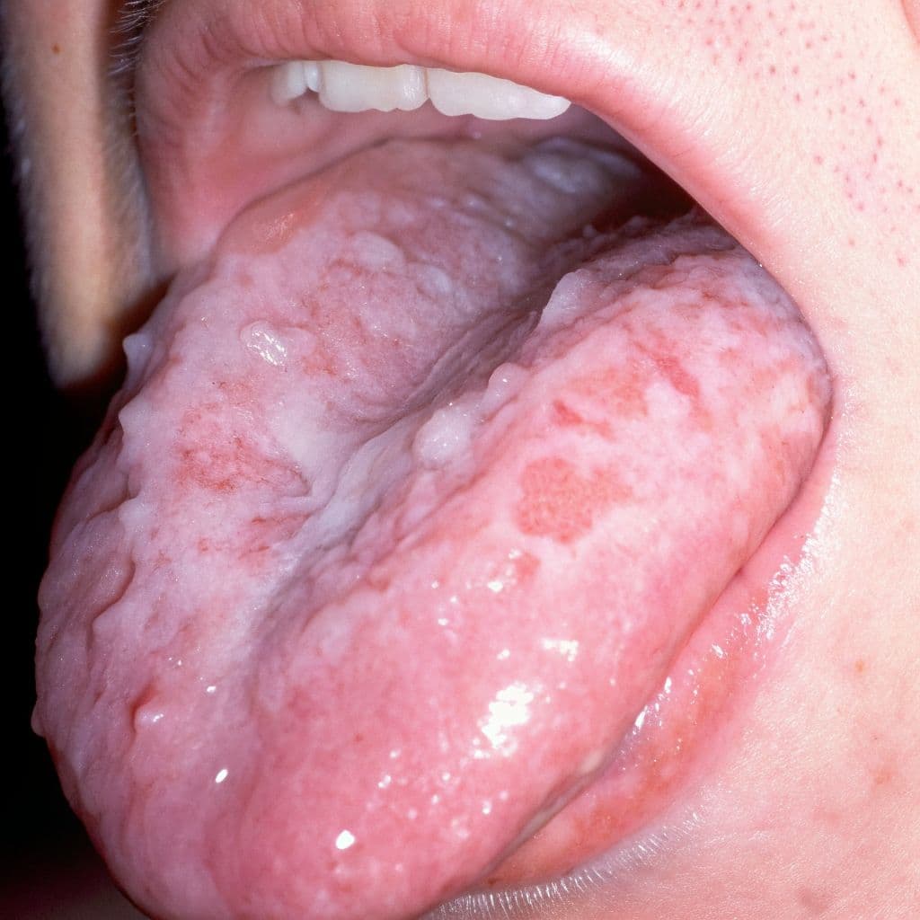 Lichen planus