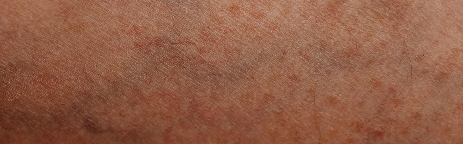 Nahaufnahme von Hautgewebe und Blutgefäßen