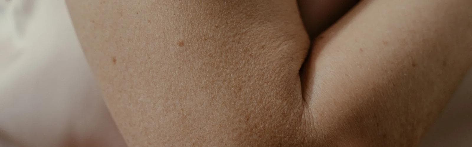 Gros plan du pli cutané du coude en lien avec le traitement du psoriasis
